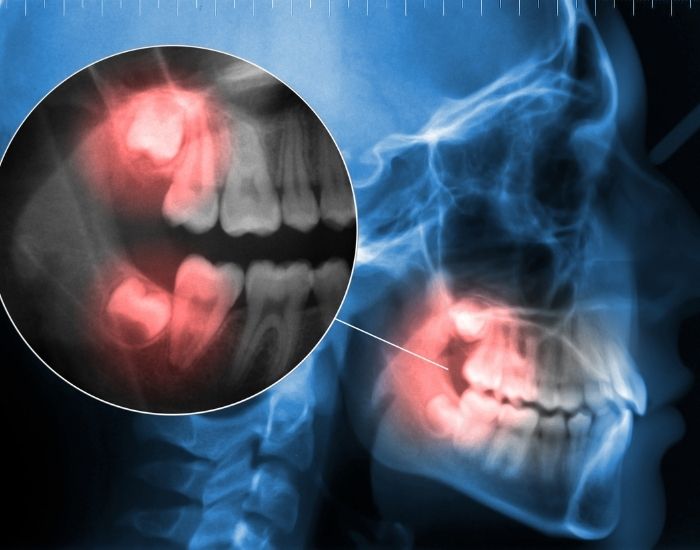 wisdom teeth removal near me (1) wisdom teeth removal