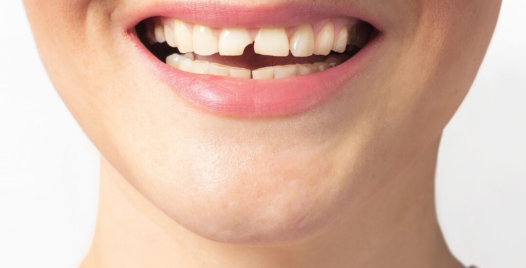 Emergency Dental Repair for a Broken Tooth: What You Need to Know