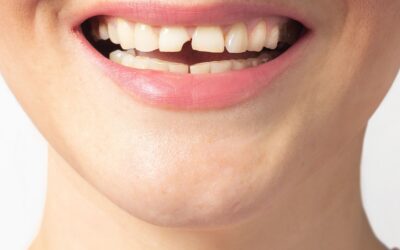 Emergency Dental Repair for a Broken Tooth: What You Need to Know