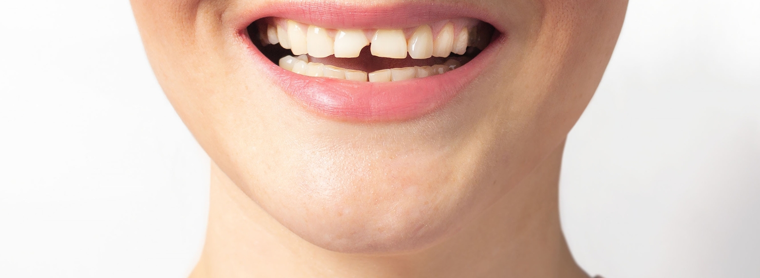 broken tooth