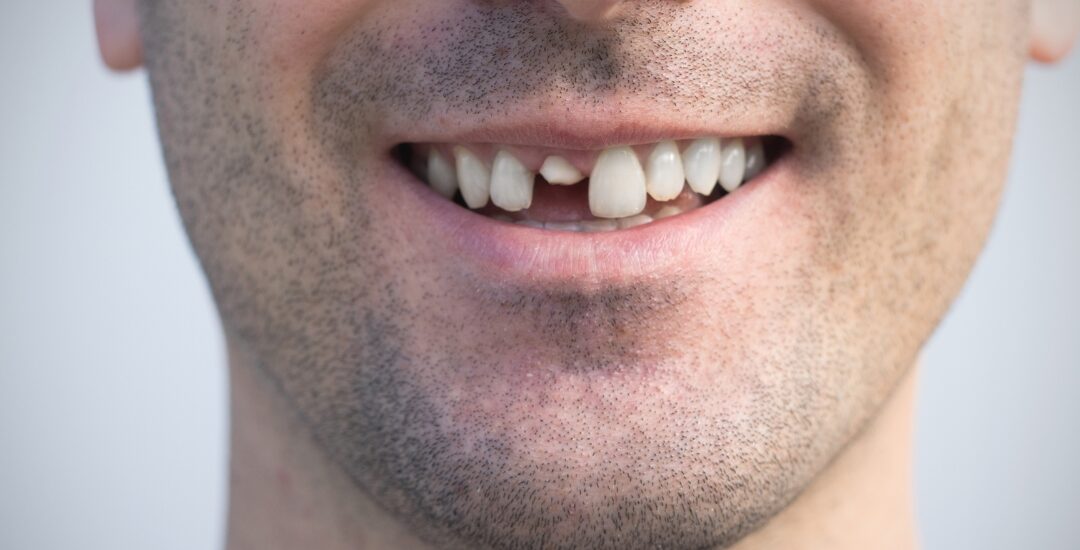 Cracked Tooth Causing Pain? When to See an Emergency Dentist