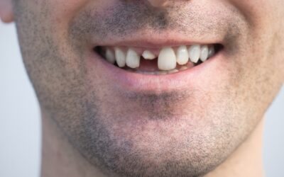 Cracked Tooth Causing Pain? When to See an Emergency Dentist