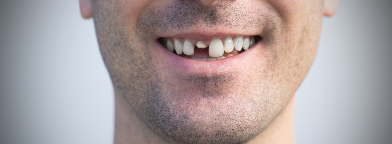 Cracked Tooth