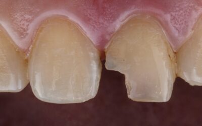 How to Fix a Chipped Front Tooth: Emergency Dental Options