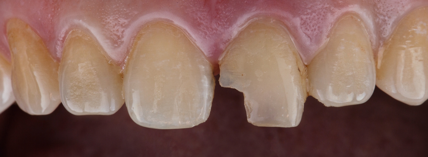 Chipped Front Tooth