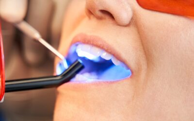 Dental Filling Fell Out? What to Do in an Emergency