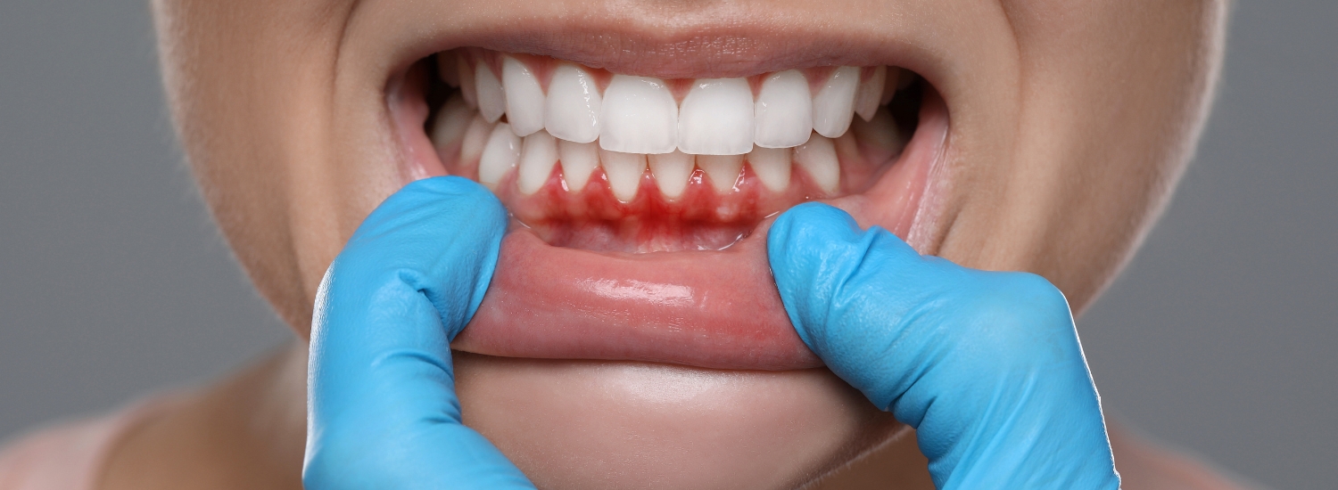 Gum Infection Treatment